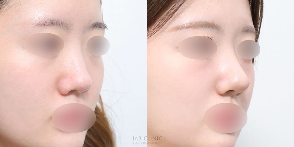 JNB Clinic: Oblique view, before and after. Original eye masking retained.